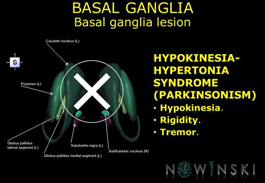 G11.T11.RegionalAnatomyDisorders.BasalGanglia.Basal ganglia lesion hypokinesia-hypertonia syndrome
