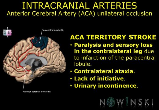 G11.T15.5.VascularDisorders.AnteriorCerebralArtery.Anterior cerebral artery unilateral occlusion