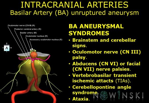 G11.T15.6.VascularDisorders.BasilarArtery.Basilar artery unruptured aneurysm