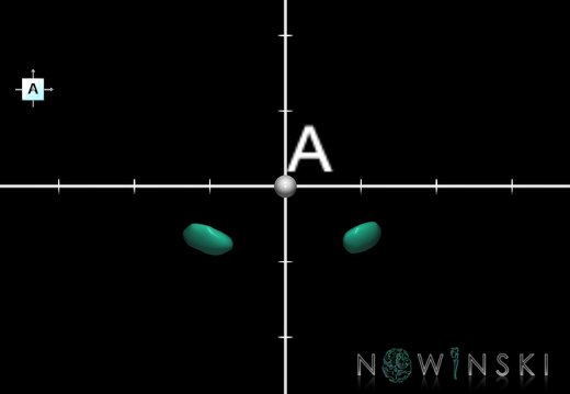 G1.T11.6.2.V1.C2.Ss.L0.Subthalamic nucleus