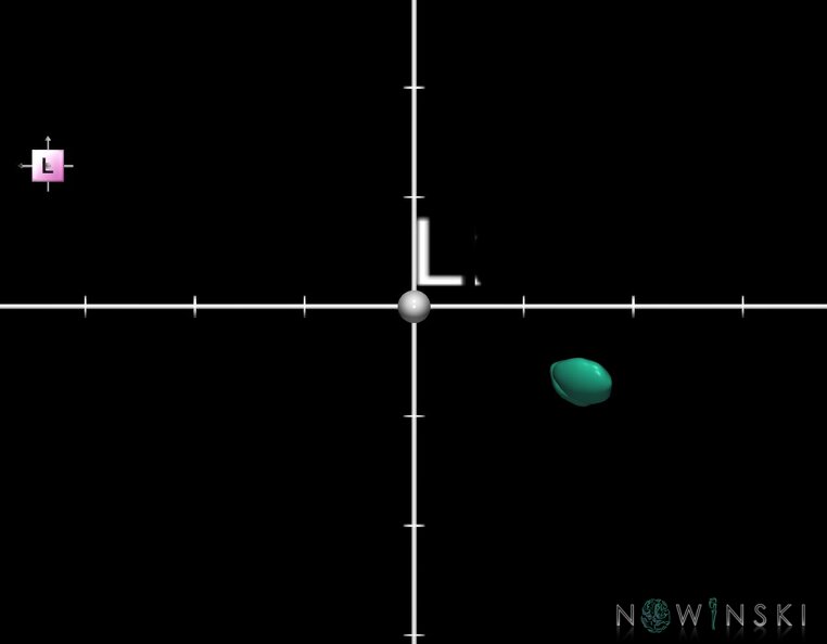 G1.T11.6.2.V2.C2.Ss.L0.Subthalamic_nucleus.tiff
