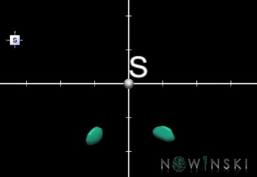 G1.T11.6.2.V5.C2.Ss.L0.Subthalamic nucleus