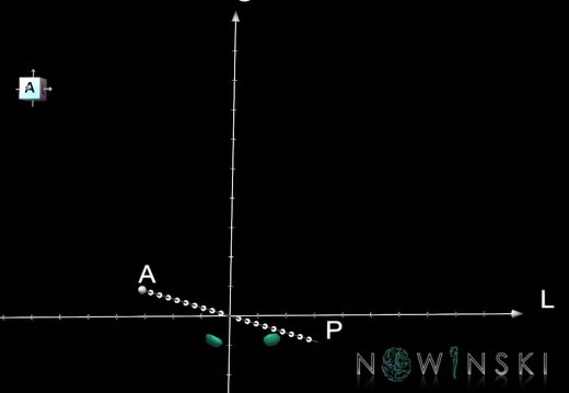 G1.T11.6.2.V7.C2.Ss.L0.Subthalamic nucleus