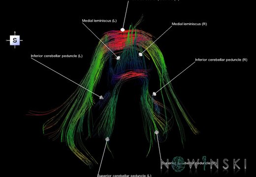 G1.T14.5.V5.C5.L1.Posterior fossa tracts