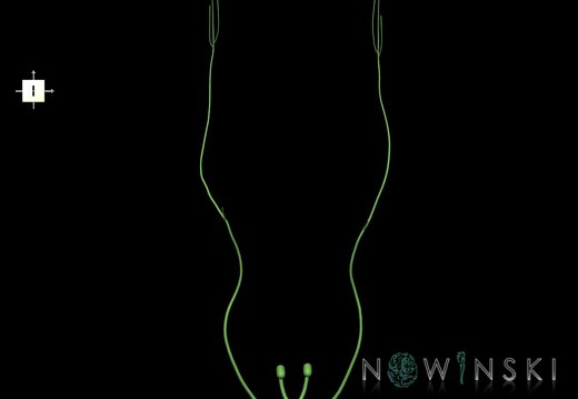 G1.T19.7.V6.C1.L0.Trochlear nerve
