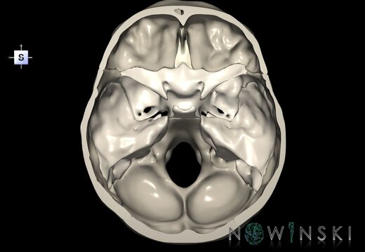 G1.T22.3.V5.C2.L0.Skull base