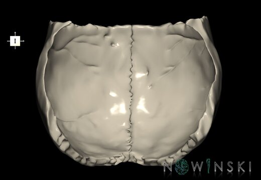 G1T22.5.7.ParietalBone