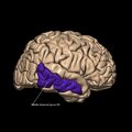 G1.T6.15.V4.C13.L1.Middle temporal gyrus right