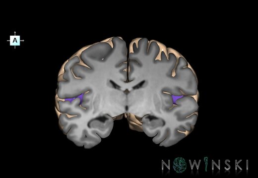 G1T6.30.TransverseTemporalGyri