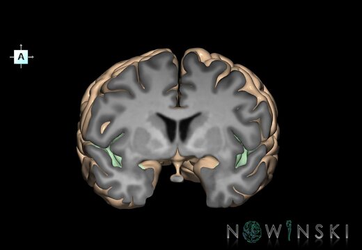 G1.T7.26.V1.C14.S1.L0.Sylvian fissure
