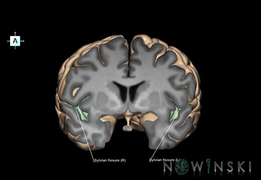 G1.T7.26.V1.C14.S1.L1.Sylvian fissure