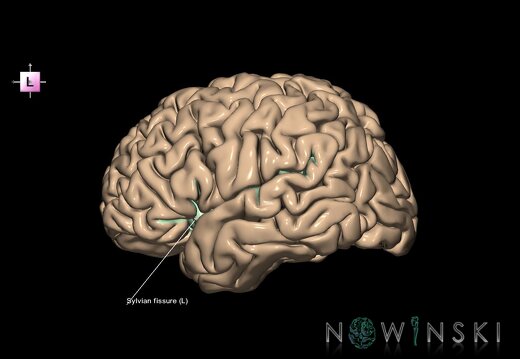 G1.T7.26.V2.C14.L1.Sylvian fissure left