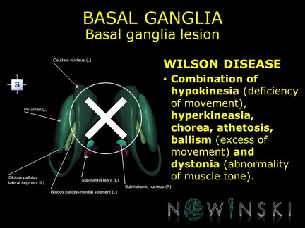 G11.T11.RegionalAnatomyDisorders.BasalGanglia.Basal ganglia lesion Wilson disease