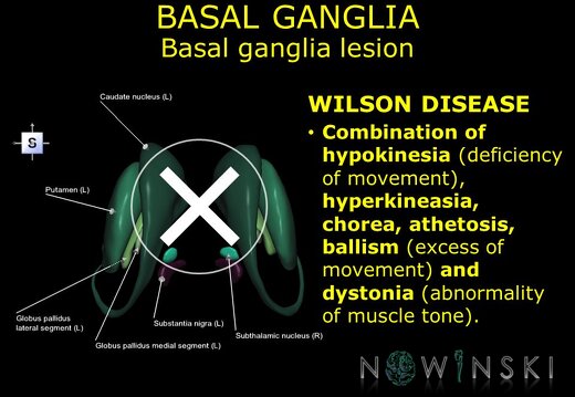 G11.T11.RegionalAnatomyDisorders.BasalGanglia.Basal ganglia lesion Wilson disease