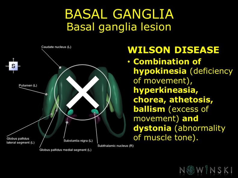 G11.T11.RegionalAnatomyDisorders.BasalGanglia.Basal_ganglia_lesion_Wilson_disease.TIF