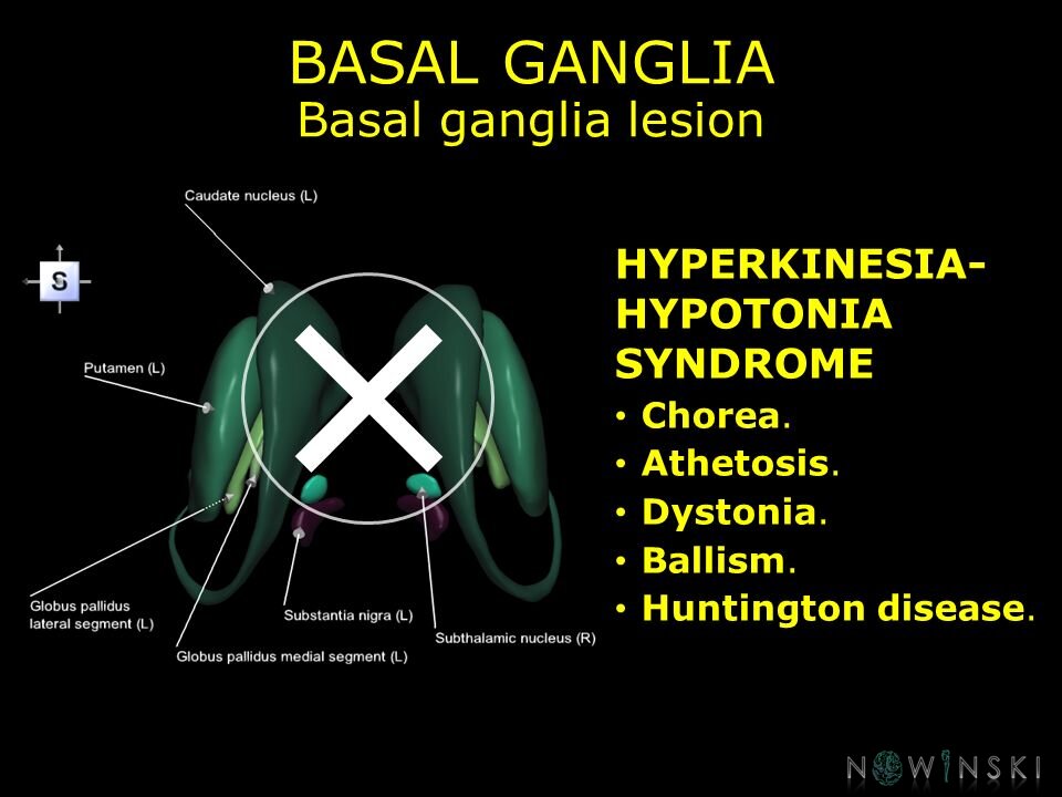 G11.T11.RegionalAnatomyDisorders.BasalGanglia.Basal ganglia lesion hyperkinesia-hypotonia syndrome
