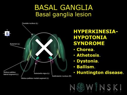 G11.T11.RegionalAnatomyDisorders.BasalGanglia.Basal ganglia lesion hyperkinesia-hypotonia syndrome