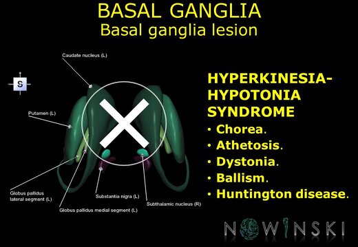 G11.T11.RegionalAnatomyDisorders.BasalGanglia.Basal ganglia lesion hyperkinesia-hypotonia syndrome