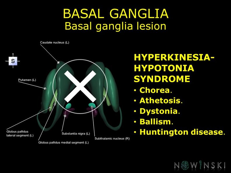 G11.T11.RegionalAnatomyDisorders.BasalGanglia.Basal_ganglia_lesion_hyperkinesia-hypotonia_syndrome.TIF