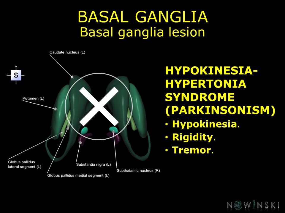 G11.T11.RegionalAnatomyDisorders.BasalGanglia.Basal ganglia lesion hypokinesia-hypertonia syndrome