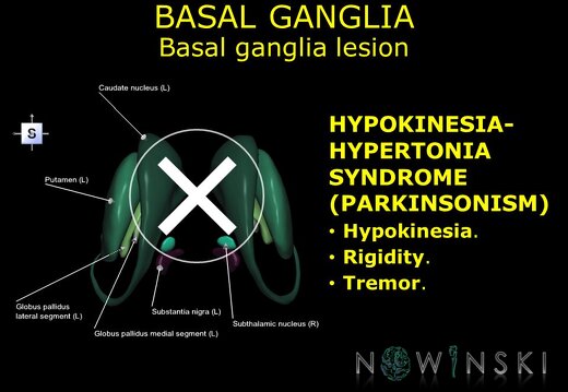 G11.T11.RegionalAnatomyDisorders.BasalGanglia.Basal ganglia lesion hypokinesia-hypertonia syndrome