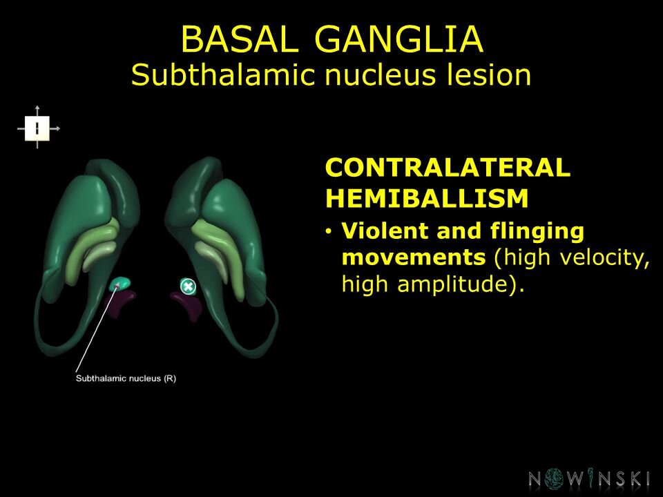 G11.T11.RegionalAnatomyDisorders.BasalGanglia.Subthalamic nucleus lesion