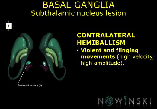 G11.T11.RegionalAnatomyDisorders.BasalGanglia.Subthalamic nucleus lesion