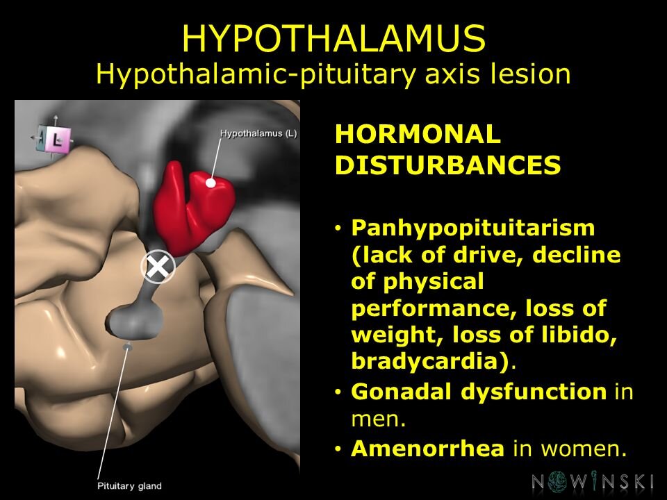 G11.T11.RegionalAnatomyDisorders.DeepNuclei.Hypothalamus.Hypothalamic-pituitary axis lesion
