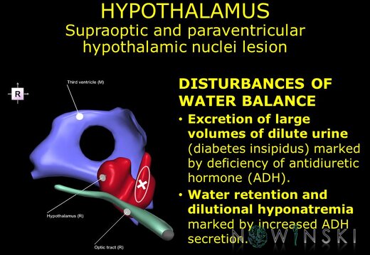 G11.T11.RegionalAnatomyDisorders.DeepNuclei.Hypothalamus.Supraoptic and paraventricular hypothalamic nuclei lesion