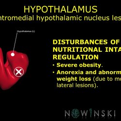 G11.T11.RegionalAnatomyDisorders.DeepNuclei.Hypothalamus.Ventromedial hypothalamic nucleus lesion