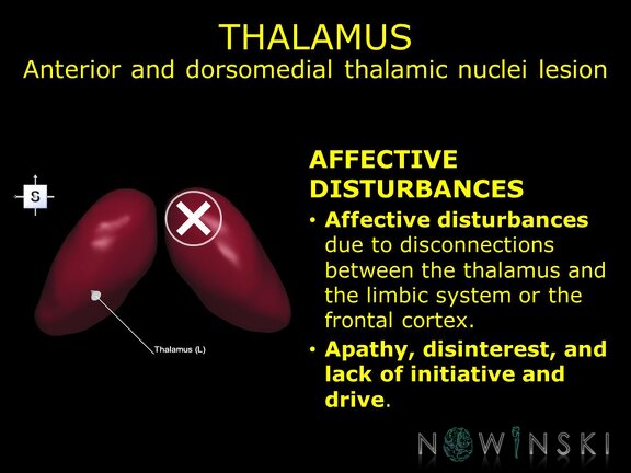 G11.T11.RegionalAnatomyDisorders.DeepNuclei.Thalamus.Anterior and dorsomedial thalamic nuclei lesion