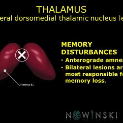 G11.T11.RegionalAnatomyDisorders.DeepNuclei.Thalamus.Bilateral dorsomedial thalamic nucleus lesion