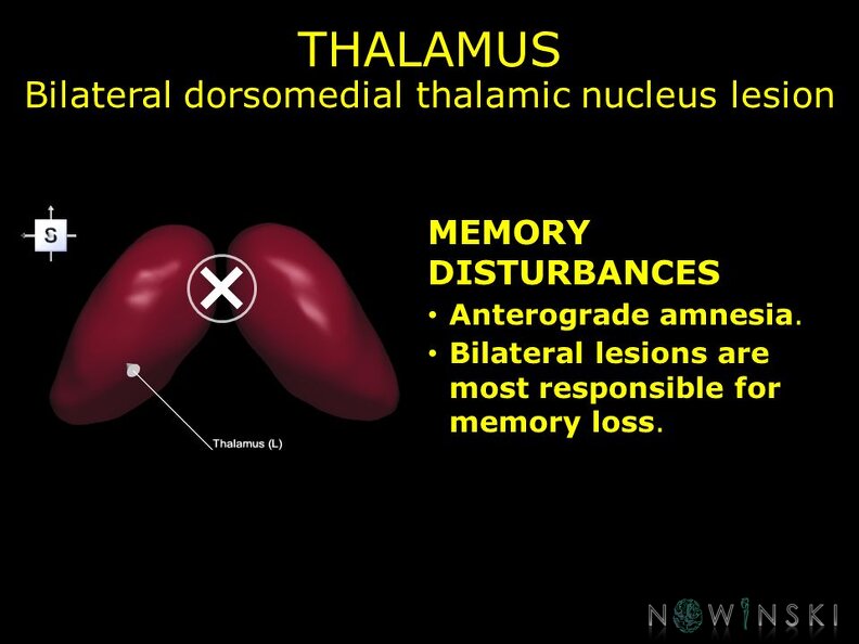 G11.T11.RegionalAnatomyDisorders.DeepNuclei.Thalamus.Bilateral dorsomedial thalamic nucleus lesion