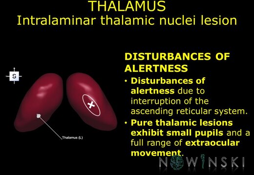 G11.T11.RegionalAnatomyDisorders.DeepNuclei.Thalamus.Intralaminar thalamic nuclei lesion