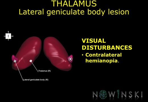 G11.T11.RegionalAnatomyDisorders.DeepNuclei.Thalamus.Lateral geniculate body lesion