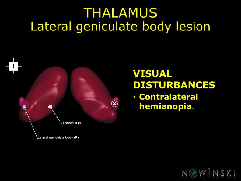 G11.T11.RegionalAnatomyDisorders.DeepNuclei.Thalamus.Lateral_geniculate_body_lesion.TIF