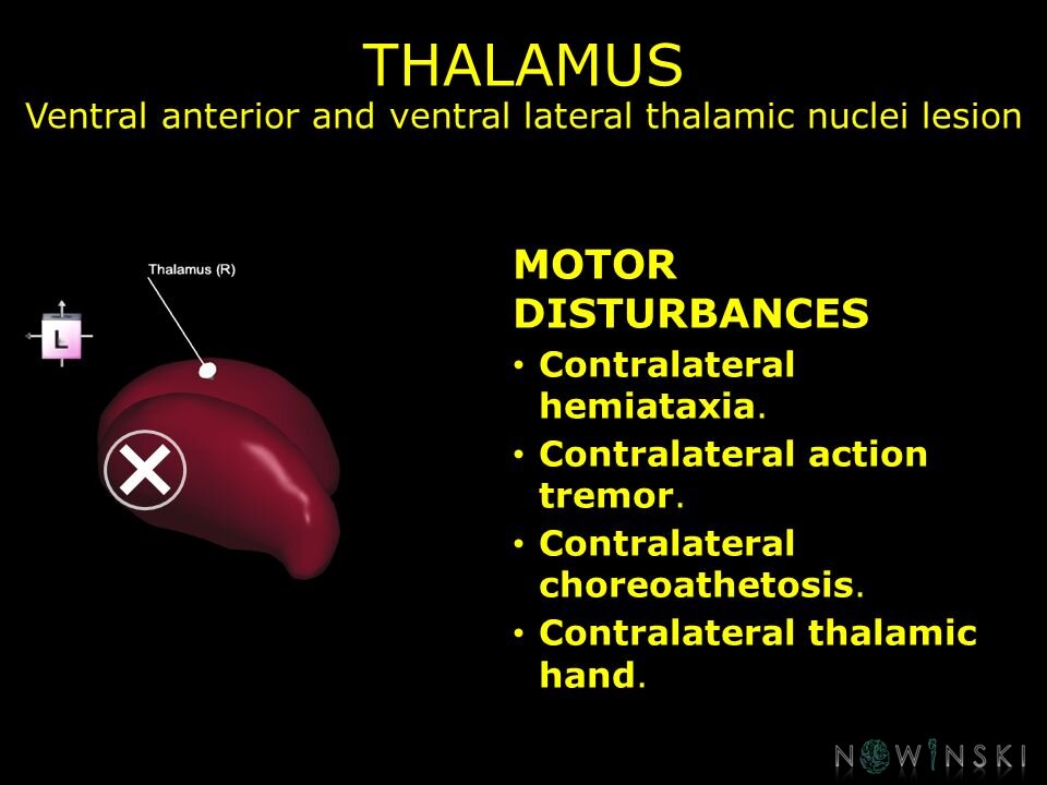 G11.T11.RegionalAnatomyDisorders.DeepNuclei.Thalamus.Ventral anterior and ventral lateral thalamic nuclei lesion