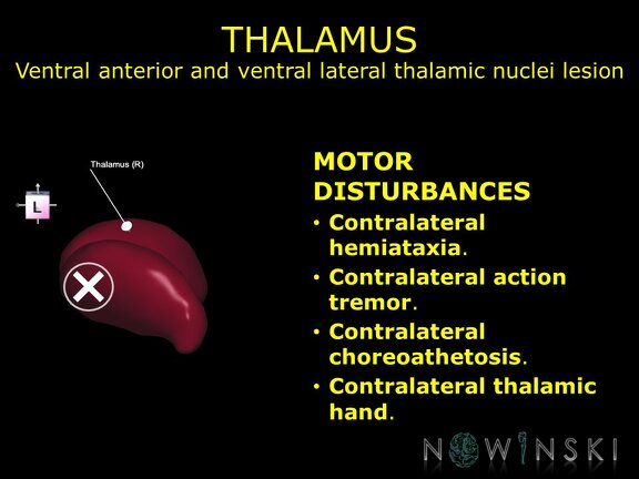 G11.T11.RegionalAnatomyDisorders.DeepNuclei.Thalamus.Ventral anterior and ventral lateral thalamic nuclei lesion