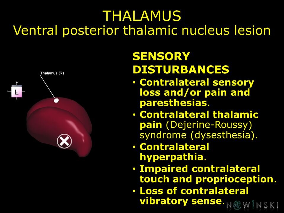 G11.T11.RegionalAnatomyDisorders.DeepNuclei.Thalamus.Ventral posterior thalamic nucleus lesion