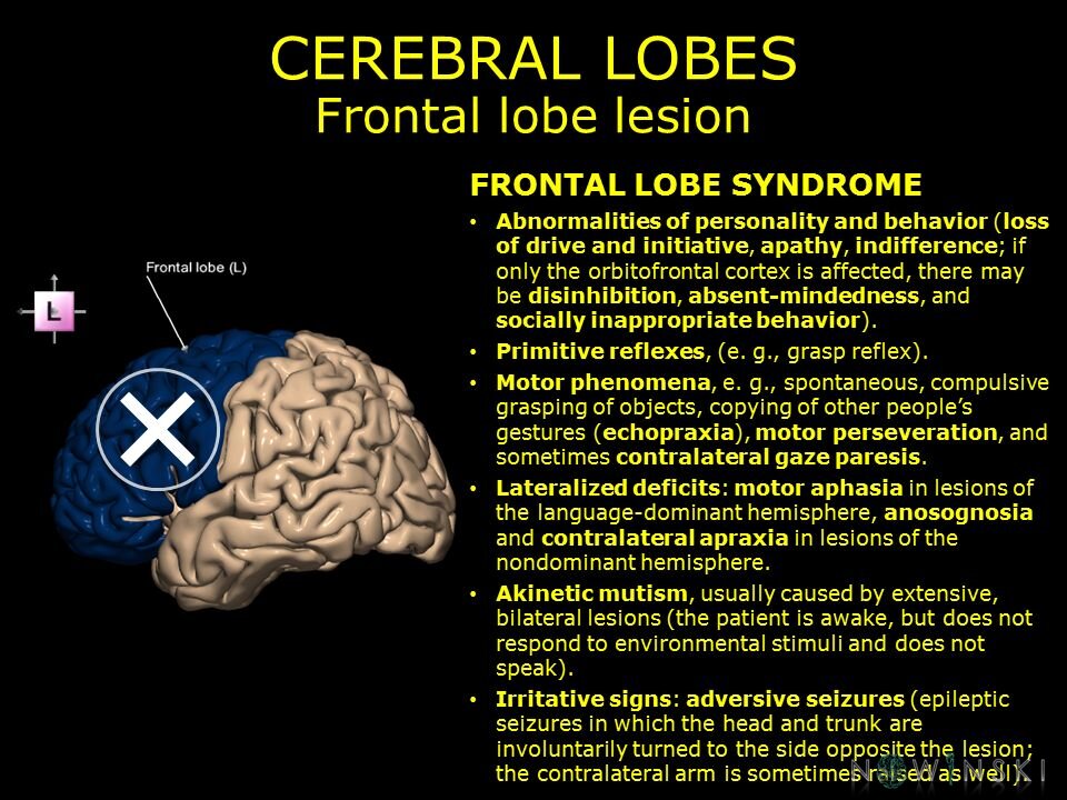 G11.T4.1.RegionalAnatomyDisorders.CerebralLobes.Frontal lobe lesion