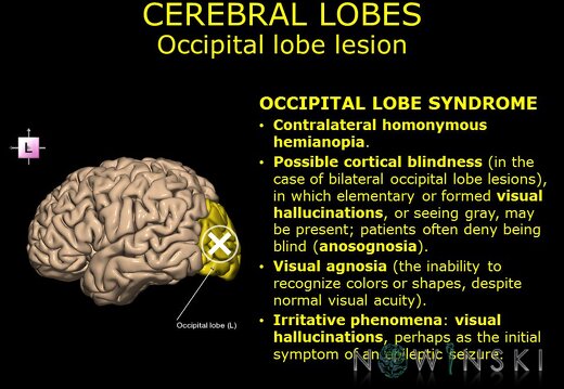 G11.T4.3.RegionalAnatomyDisorders.CerebralLobes.Occipital lobe lesion