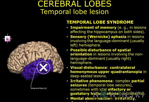 G11.T4.4.RegionalAnatomyDisorders.CerebralLobes.Temporal lobe lesion