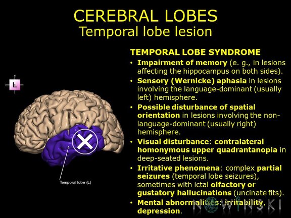 G11.T4.4.RegionalAnatomyDisorders.CerebralLobes.Temporal lobe lesion