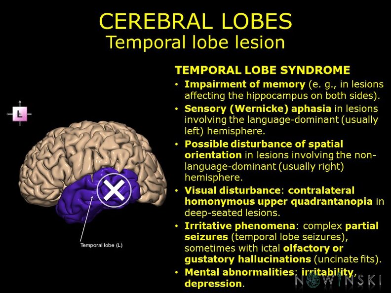 G11.T4.4.RegionalAnatomyDisorders.CerebralLobes.Temporal_lobe_lesion.TIF