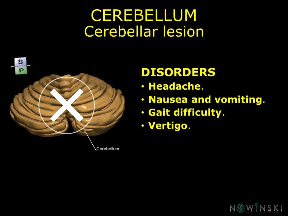 G11.T8.RegionalAnatomyDisorders.Cerebellum.Cerebellar lesion