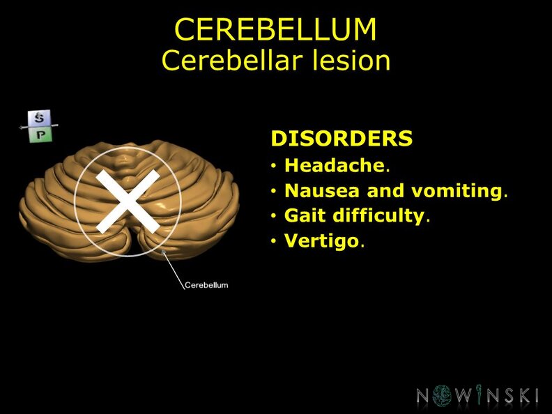 G11.T8.RegionalAnatomyDisorders.Cerebellum.Cerebellar_lesion.TIF