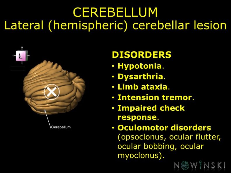 G11.T8.RegionalAnatomyDisorders.Cerebellum.Lateral hemispheric cerebellar lesion