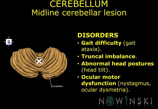 G11.T8.RegionalAnatomyDisorders.Cerebellum.Midline cerebellar lesion
