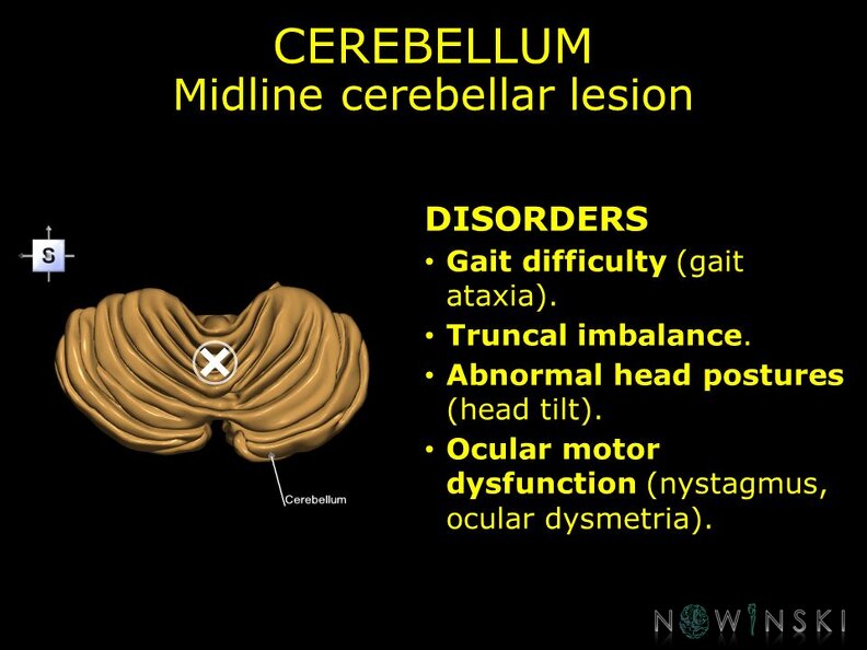 G11.T8.RegionalAnatomyDisorders.Cerebellum.Midline_cerebellar_lesion.TIF