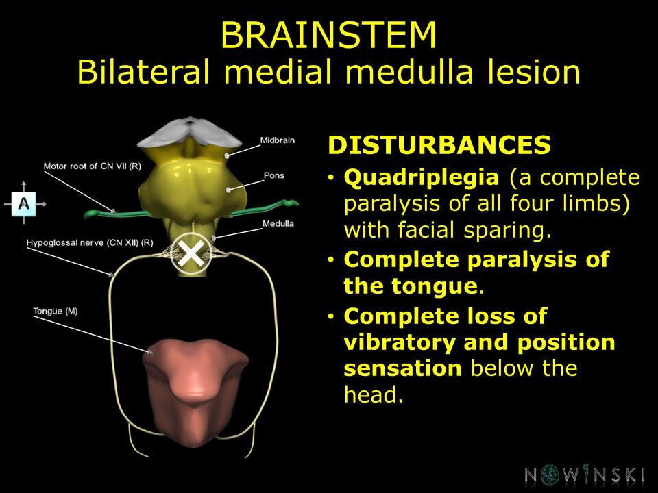 G11.T9.RegionalAnatomyDisorders.Brainstem.Medulla bilateral medial lesion